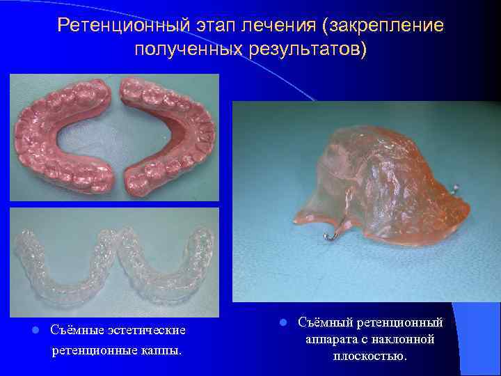 Ретенционный этап лечения (закрепление полученных результатов) l Съёмные эстетические ретенционные каппы. l Съёмный ретенционный