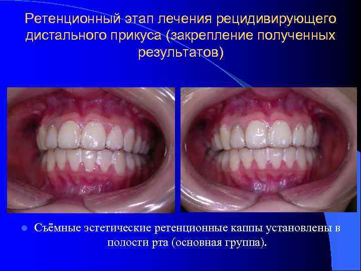 Ретенционный этап лечения рецидивирующего дистального прикуса (закрепление полученных результатов) l Съёмные эстетические ретенционные каппы