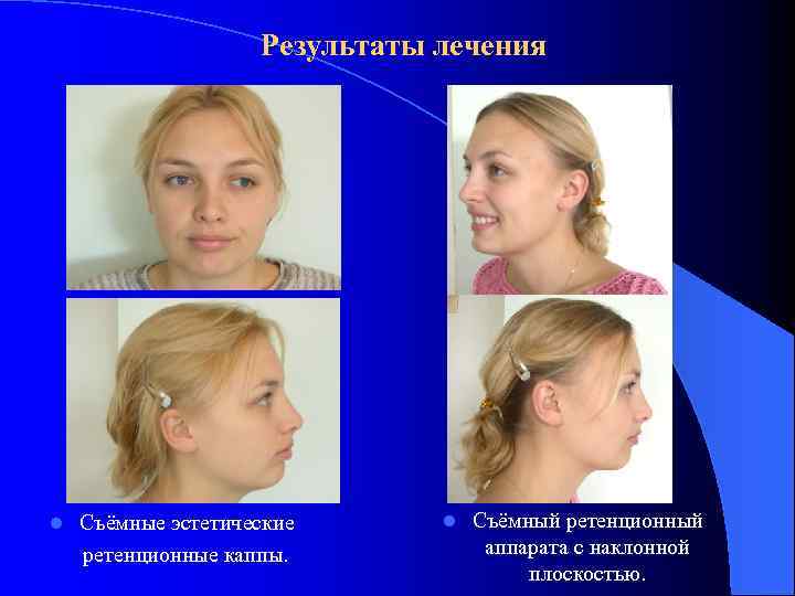 Результаты лечения l Съёмные эстетические ретенционные каппы. l Съёмный ретенционный аппарата с наклонной плоскостью.