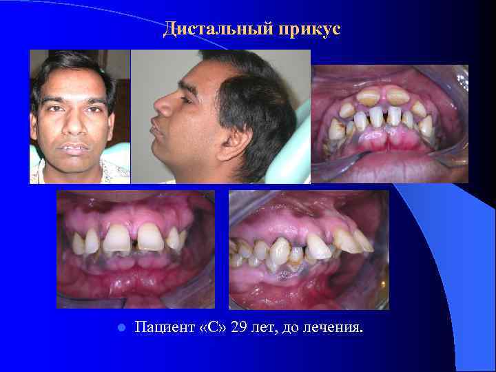 Дистальный прикус l Пациент «С» 29 лет, до лечения. 