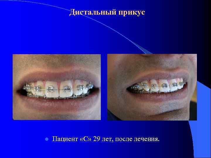 Дистальный прикус l Пациент «С» 29 лет, после лечения. 