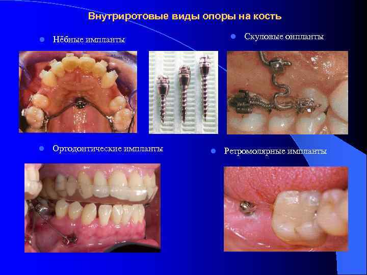 Внутриротовые виды опоры на кость l l Ортодонтические импланты l Нёбные импланты l Скуловые