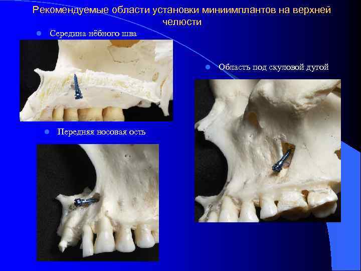 Рекомендуемые области установки миниимплантов на верхней челюсти l Середина нёбного шва l l Передняя