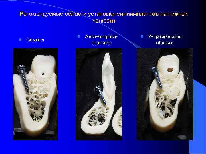 Рекомендуемые области установки миниимплантов на нижней челюсти l Симфиз l Альвеолярный отросток l Ретромолярная