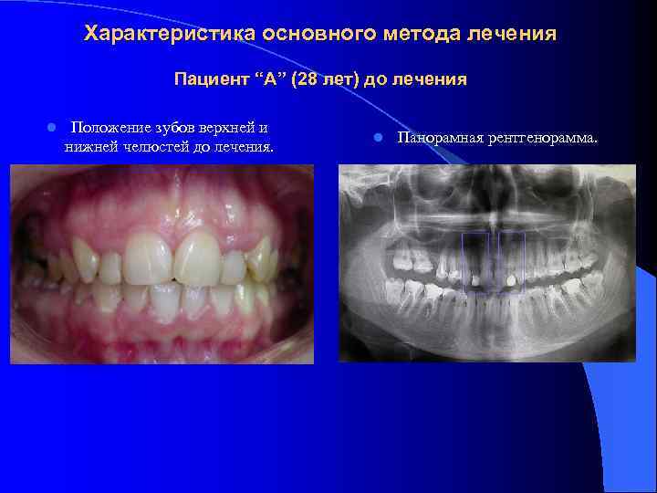 Характеристика основного метода лечения Пациент “А” (28 лет) до лечения l Положение зубов верхней