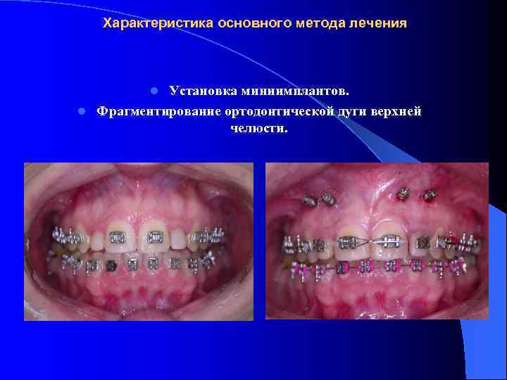 Характеристика основного метода лечения Установка миниимплантов. l Фрагментирование ортодонтической дуги верхней челюсти. l 