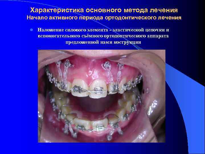 Характеристика основного метода лечения Начало активного периода ортодонтического лечения l Наложение силового элемента -