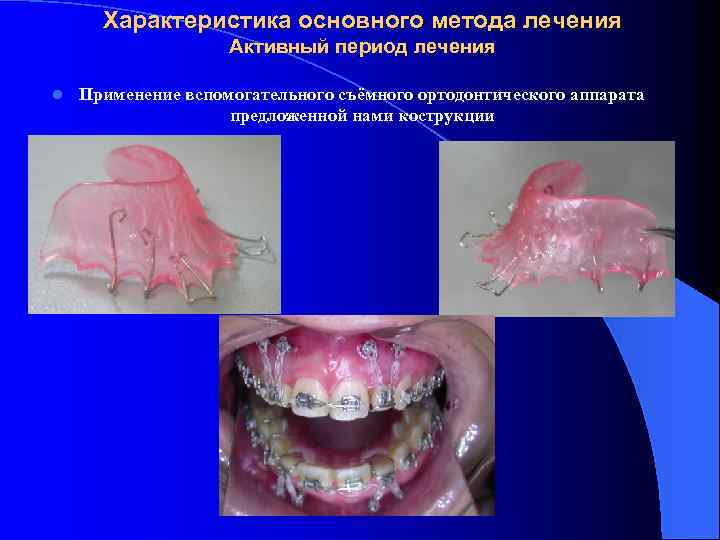 Характеристика основного метода лечения Активный период лечения l Применение вспомогательного съёмного ортодонтического аппарата предложенной