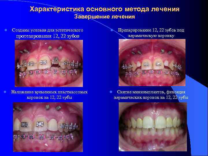 Характеристика основного метода лечения Завершение лечения l Созданы условия для эстетического l Препарирование 12,