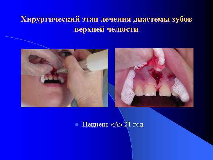 Хирургический этап лечения диастемы зубов верхней челюсти l Пациент «А» 21 год. 
