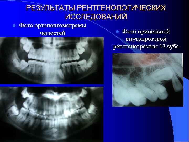 РЕЗУЛЬТАТЫ РЕНТГЕНОЛОГИЧЕСКИХ ИССЛЕДОВАНИЙ l Фото ортопантомограмы челюстей Фото прицельной внутриротовой рентгенограммы 13 зуба l