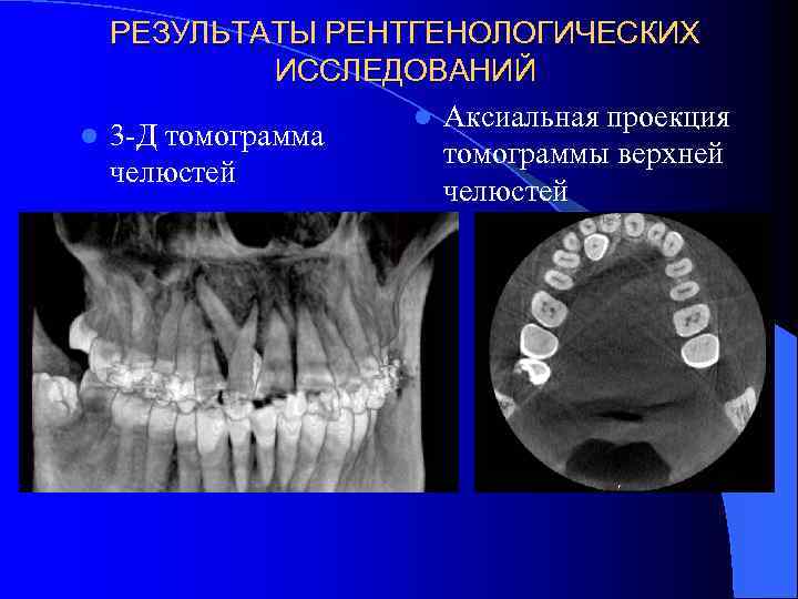 РЕЗУЛЬТАТЫ РЕНТГЕНОЛОГИЧЕСКИХ ИССЛЕДОВАНИЙ l Аксиальная проекция l 3 -Д томограмма томограммы верхней челюстей 