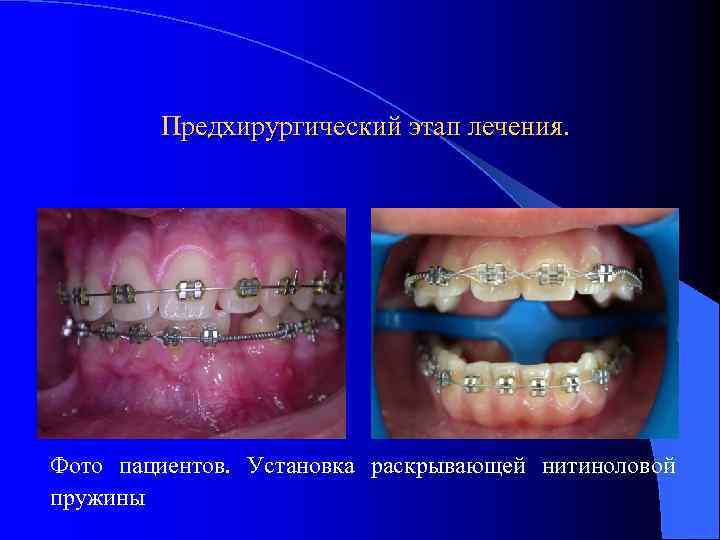 Предхирургический этап лечения. Фото пациентов. Установка раскрывающей нитиноловой пружины 