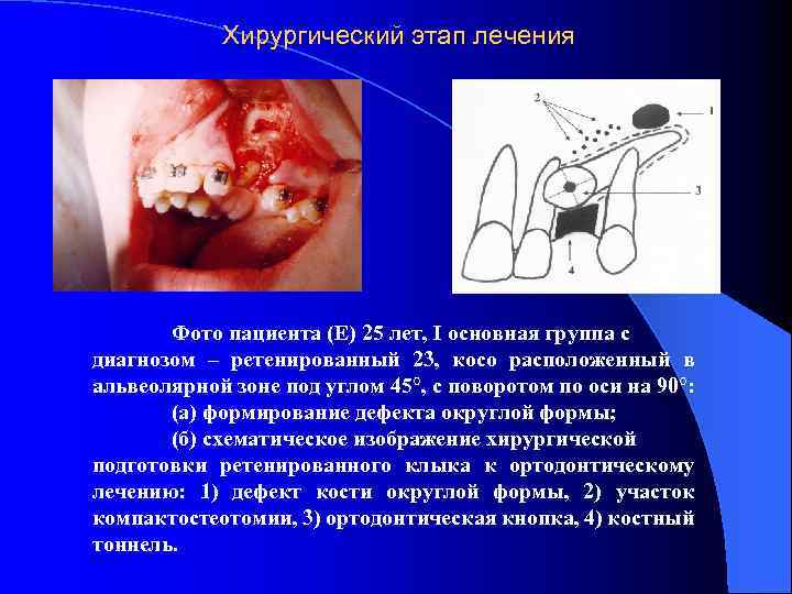 Хирургический этап лечения Фото пациента (Е) 25 лет, I основная группа с диагнозом –