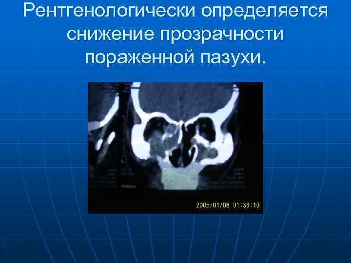 Рентгенологически определяется снижение прозрачности  пораженной пазухи. 