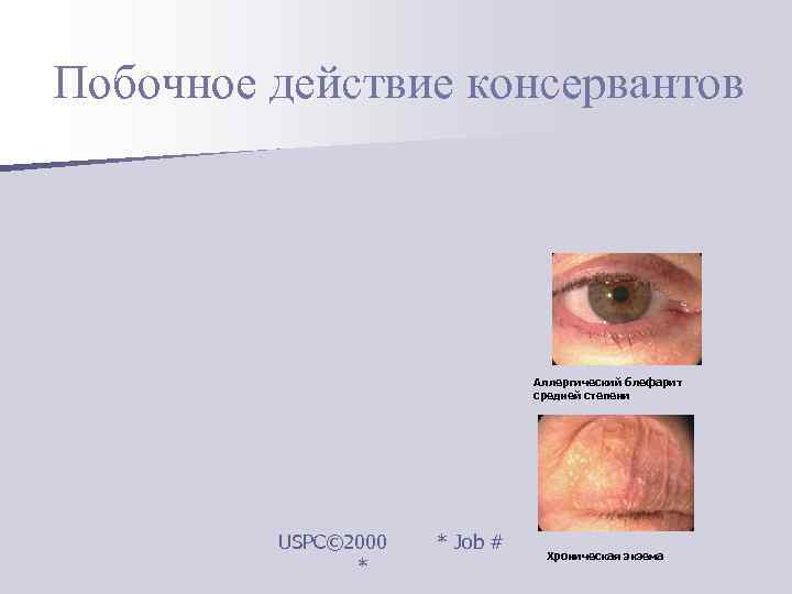 Побочное действие консервантов       Аллергический блефарит   