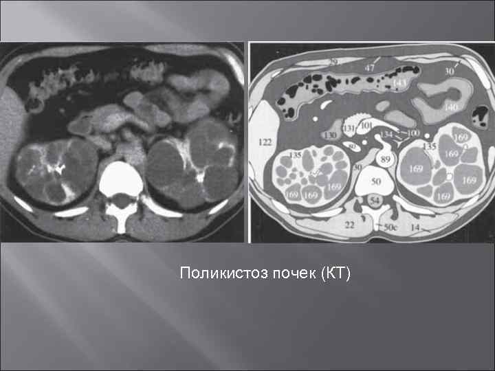 Поликистоз почек (КТ) 