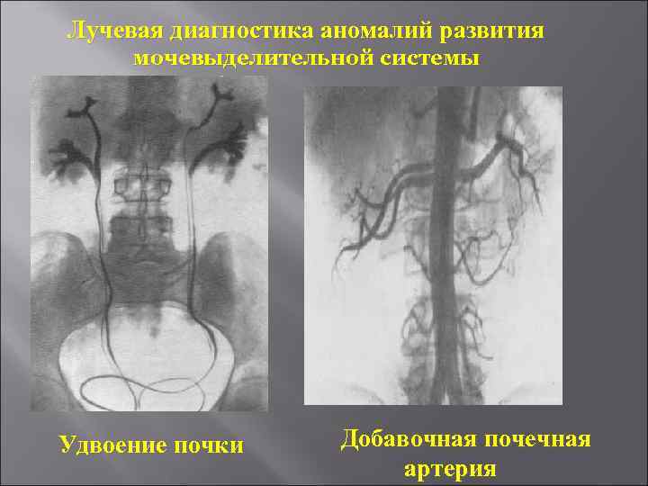 Лучевая диагностика мочевыделительной системы презентация