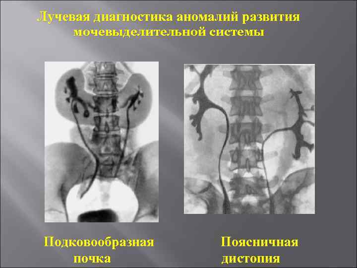 Лучевая диагностика почек презентация