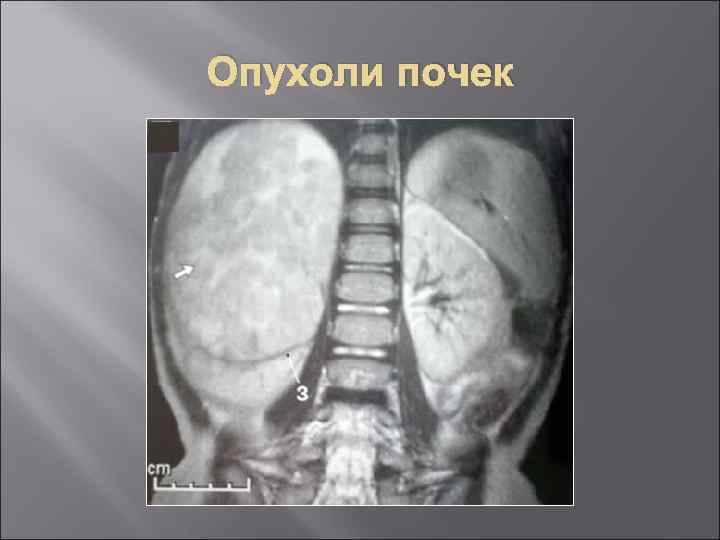 Опухоли почек 