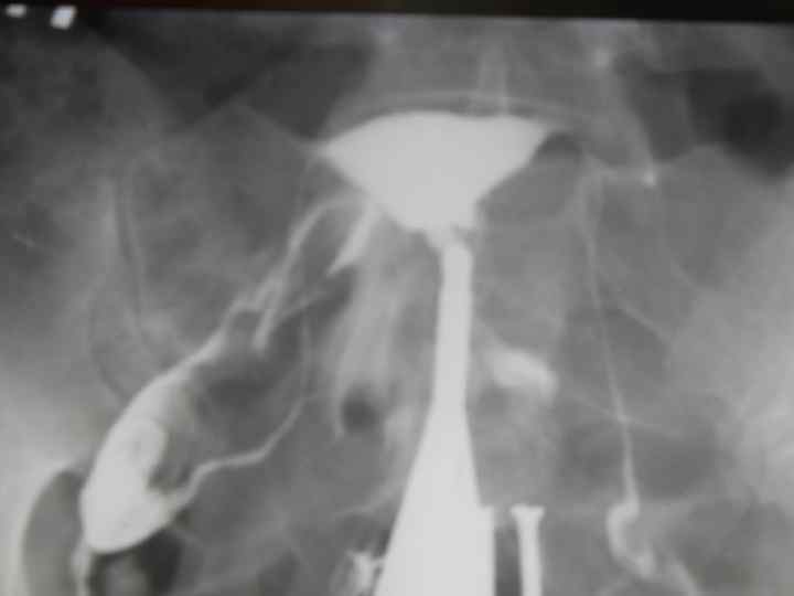  Посттравматическая гематома, подострая субкапсулярная гематома правой почки МРТ Т 2 ВИ 