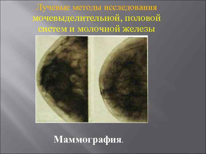  Лучевые методы исследования мочевыделительной, половой систем и молочной железы   Маммография. 