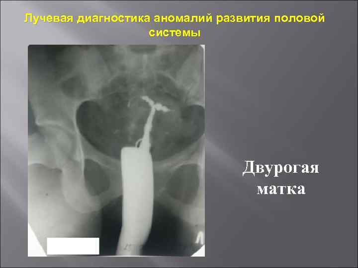 Лучевая диагностика аномалий развития половой    системы     