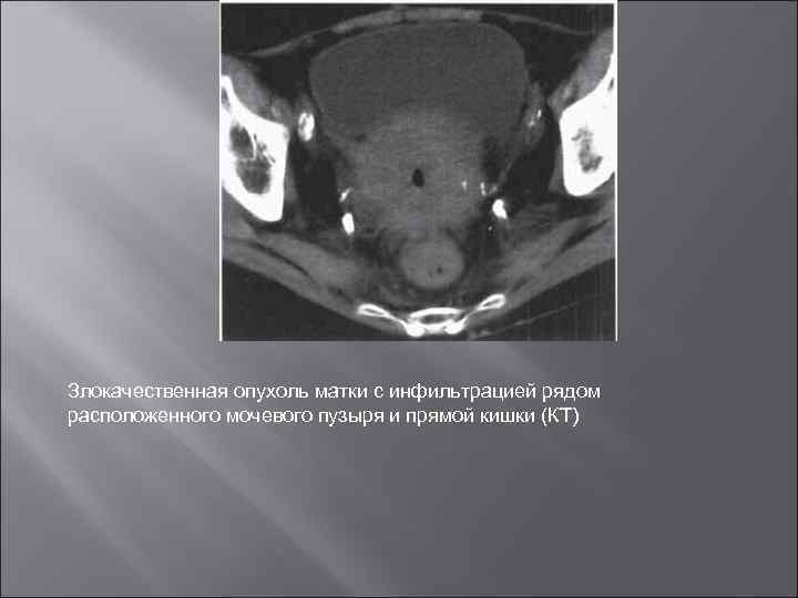 Злокачественная опухоль матки с инфильтрацией рядом расположенного мочевого пузыря и прямой кишки (КТ) 