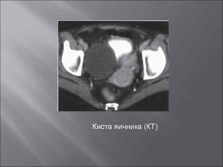 Киста яичника (КТ) 