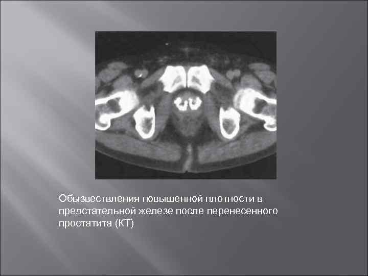Обызвествления повышенной плотности в предстательной железе после перенесенного простатита (КТ) 