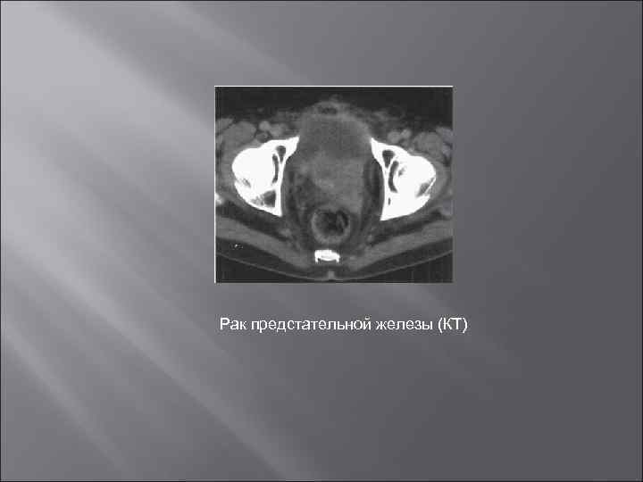 Рак предстательной железы (КТ) 