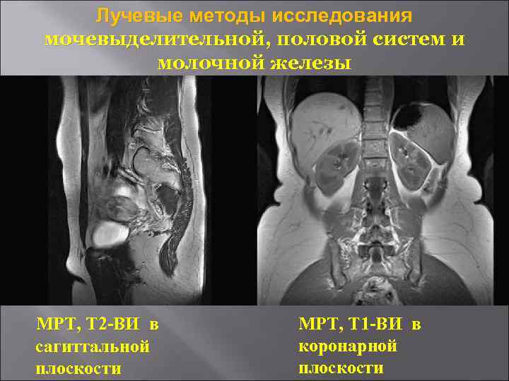   Лучевые методы исследования мочевыделительной, половой систем и   молочной железы МРТ,