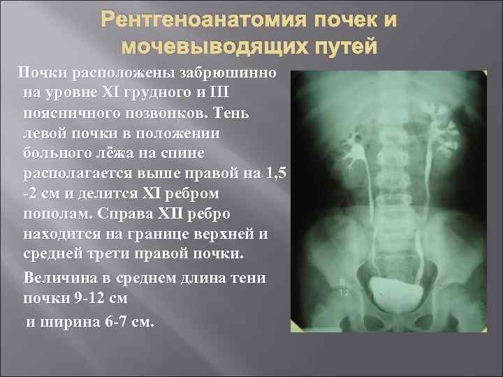    Рентгеноанатомия почек и  мочевыводящих путей Почки расположены забрюшинно на уровне