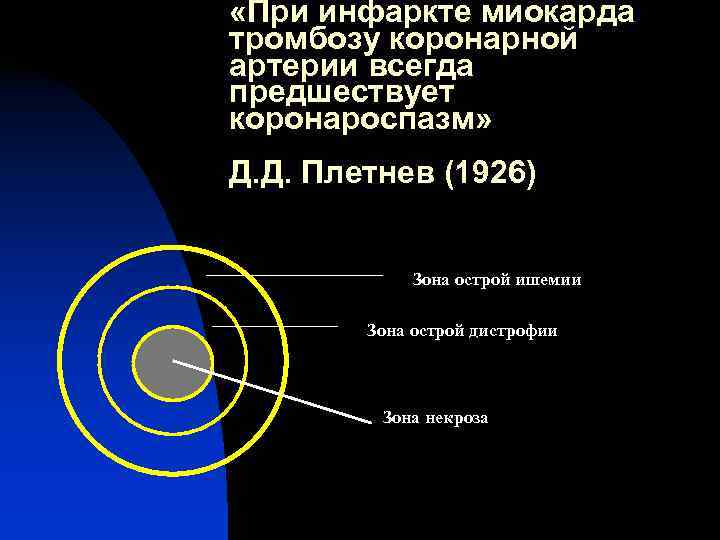 «При инфаркте миокарда тромбозу коронарной артерии всегда предшествует коронароспазм» Д. Д. Плетнев (1926) «При инфаркте миокарда тромбозу коронарной артерии всегда предшествует коронароспазм» Д. Д. Плетнев (1926)