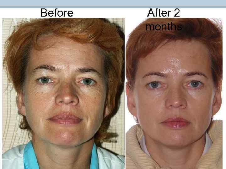 Before After 2 months Before After 2 months