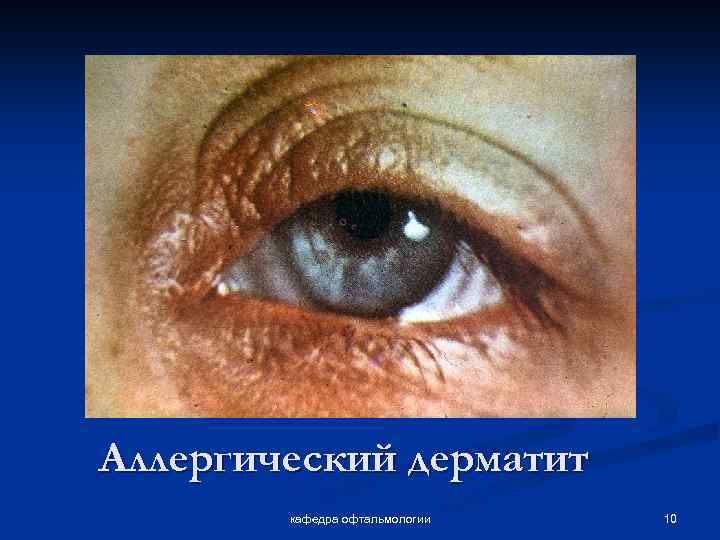 Аллергический дерматит кафедра офтальмологии 10 