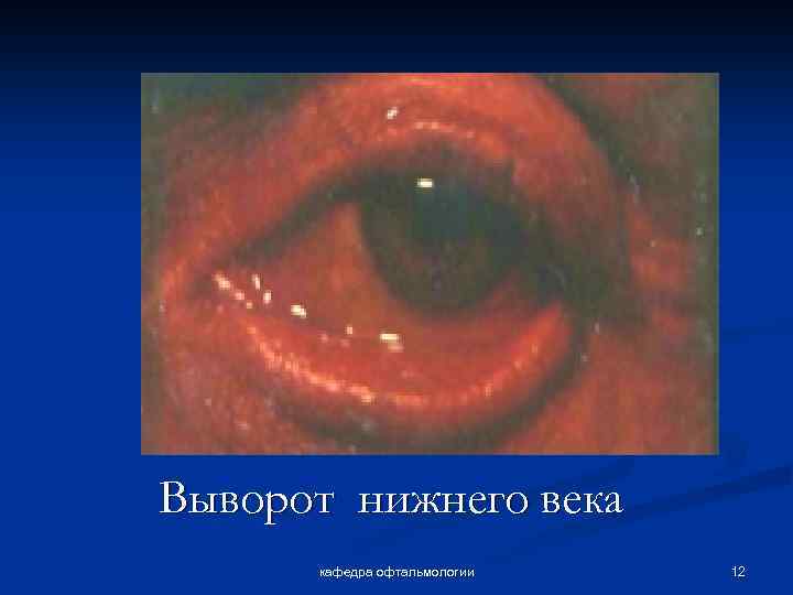 Выворот нижнего века кафедра офтальмологии 12 