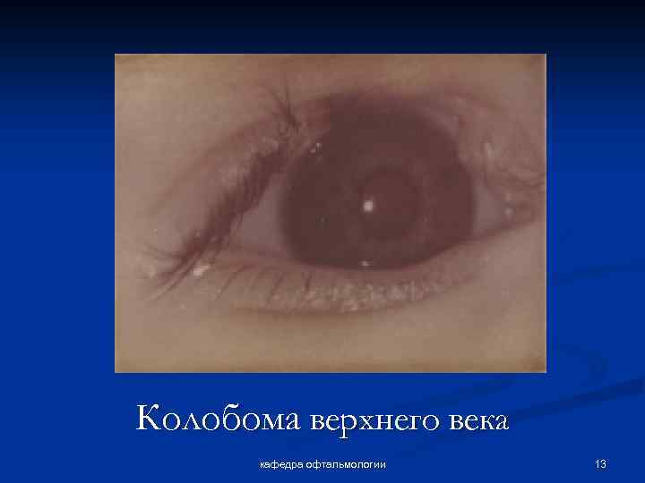 Колобома верхнего века кафедра офтальмологии 13 
