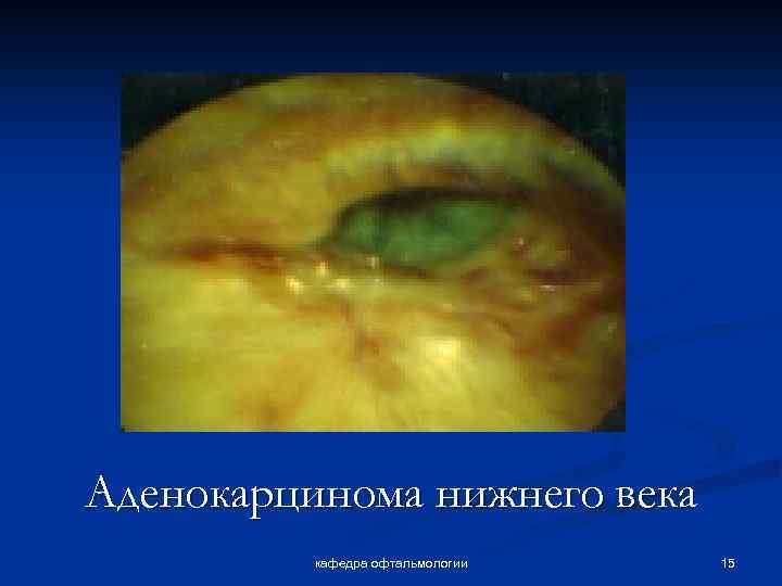 Аденокарцинома нижнего века кафедра офтальмологии 15 