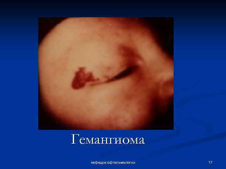 Гемангиома кафедра офтальмологии 17 