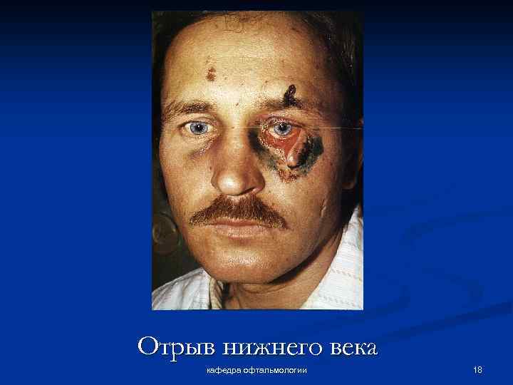 Отрыв нижнего века кафедра офтальмологии 18 