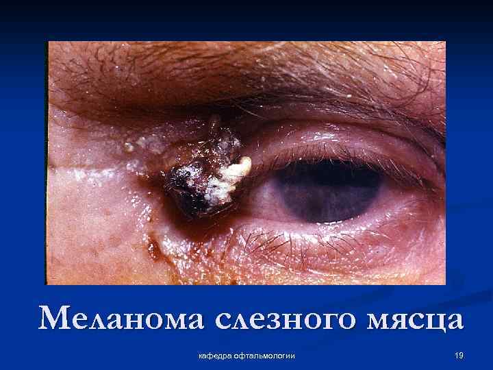 Меланома слезного мясца кафедра офтальмологии 19 