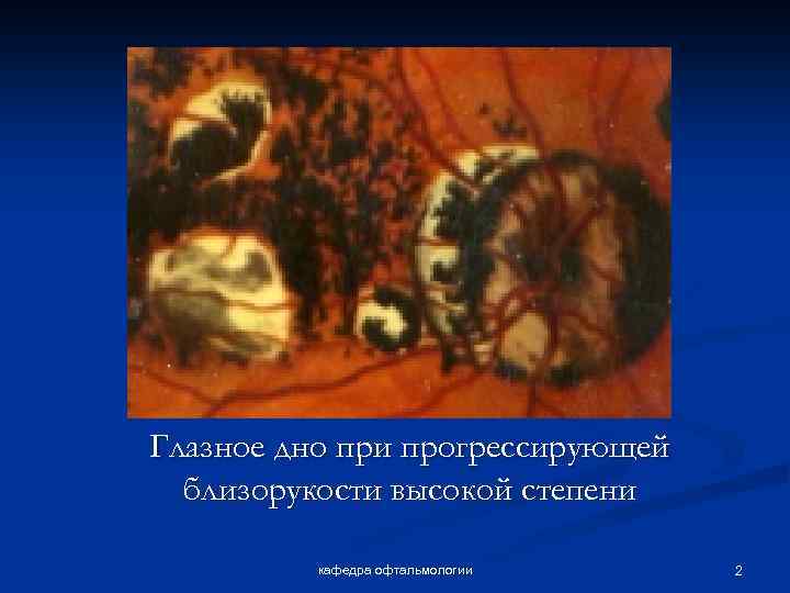 Глазное дно при прогрессирующей близорукости высокой степени кафедра офтальмологии 2 