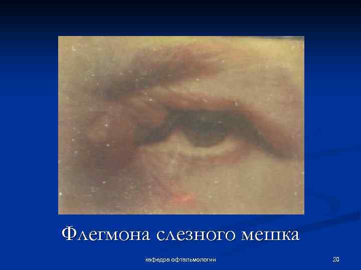 Флегмона слезного мешка кафедра офтальмологии 20 
