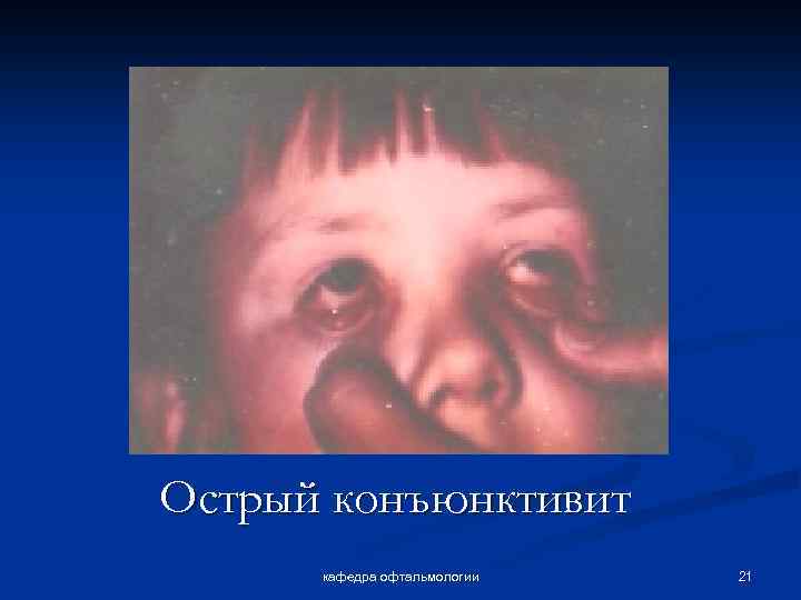 Острый конъюнктивит кафедра офтальмологии 21 