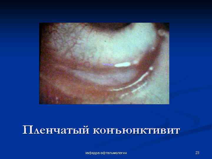 Пленчатый конъюнктивит кафедра офтальмологии 23 