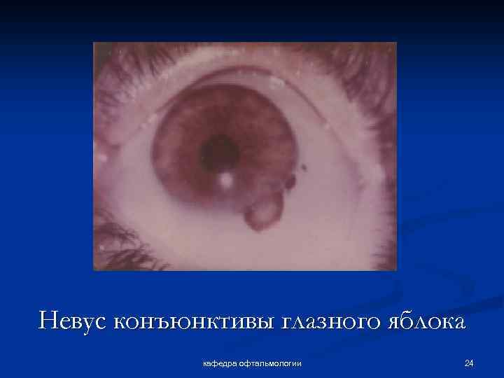 Невус конъюнктивы глазного яблока кафедра офтальмологии 24 