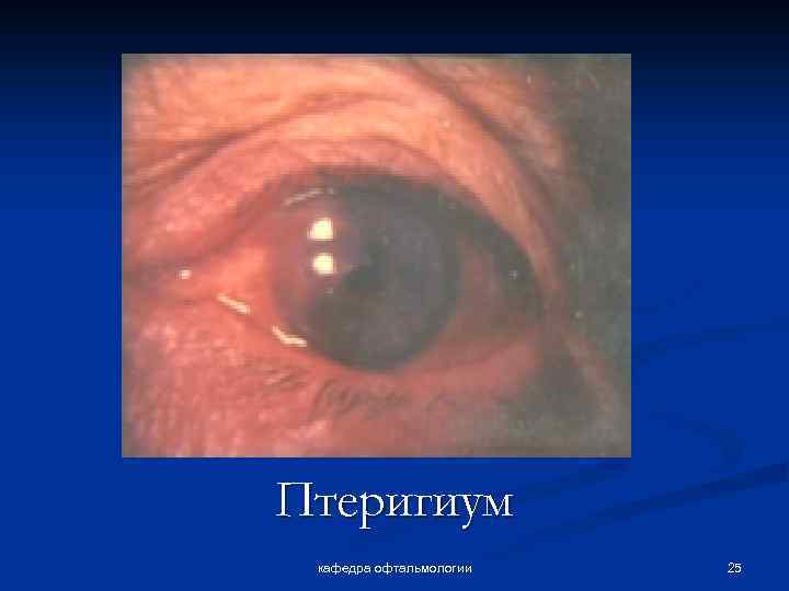 Птеригиум кафедра офтальмологии 25 