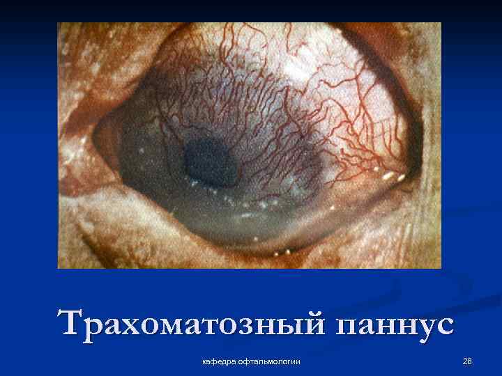 Трахоматозный паннус кафедра офтальмологии 26 