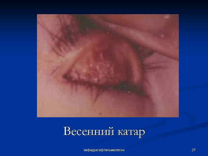Весенний катар кафедра офтальмологии 27 
